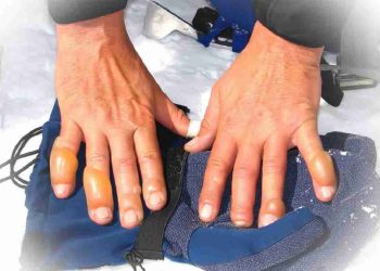 Đá khô nguy hiểm thế nào?