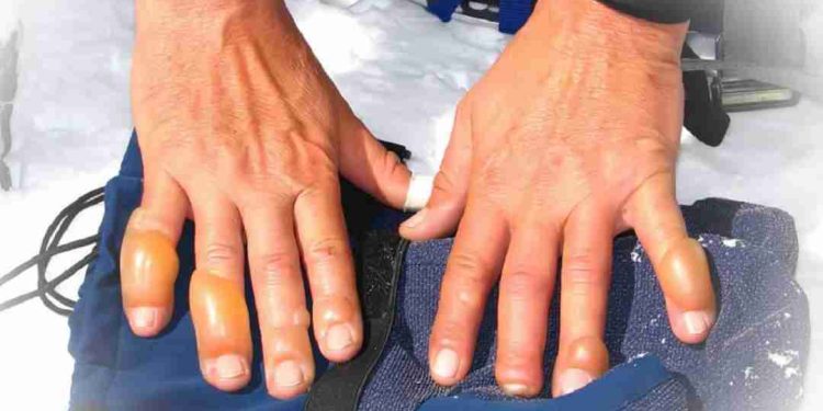 Đá khô nguy hiểm thế nào?